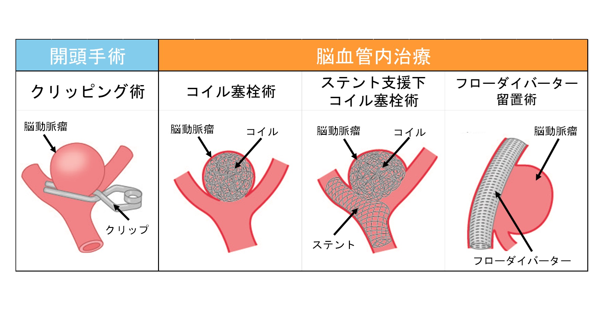 クリップ コイル ステント支援コイル