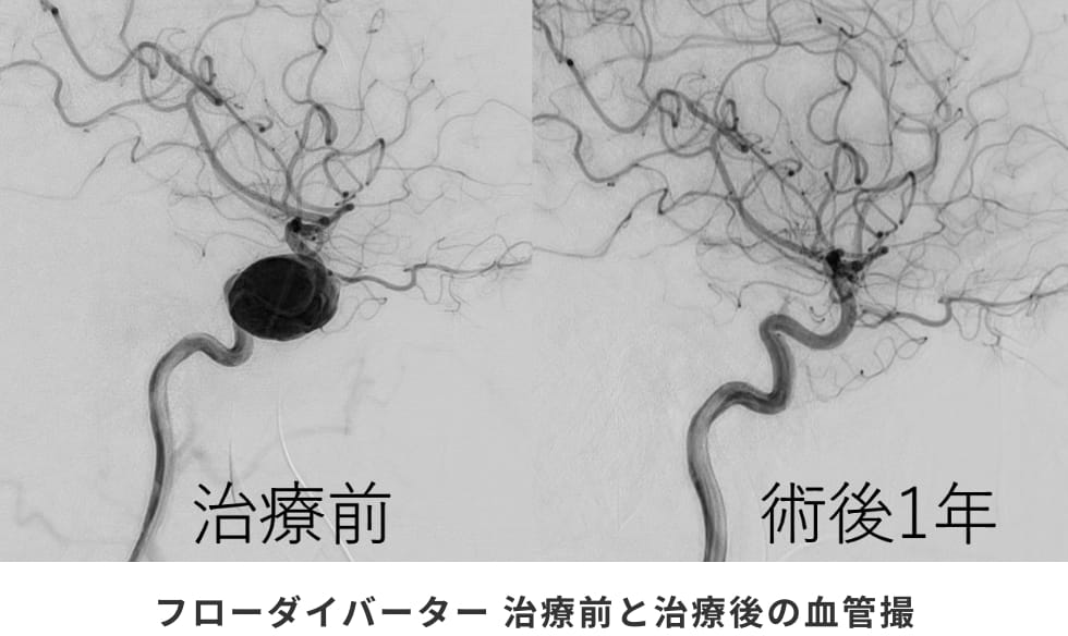 フローダイバーター 治療前と治療後の血管撮