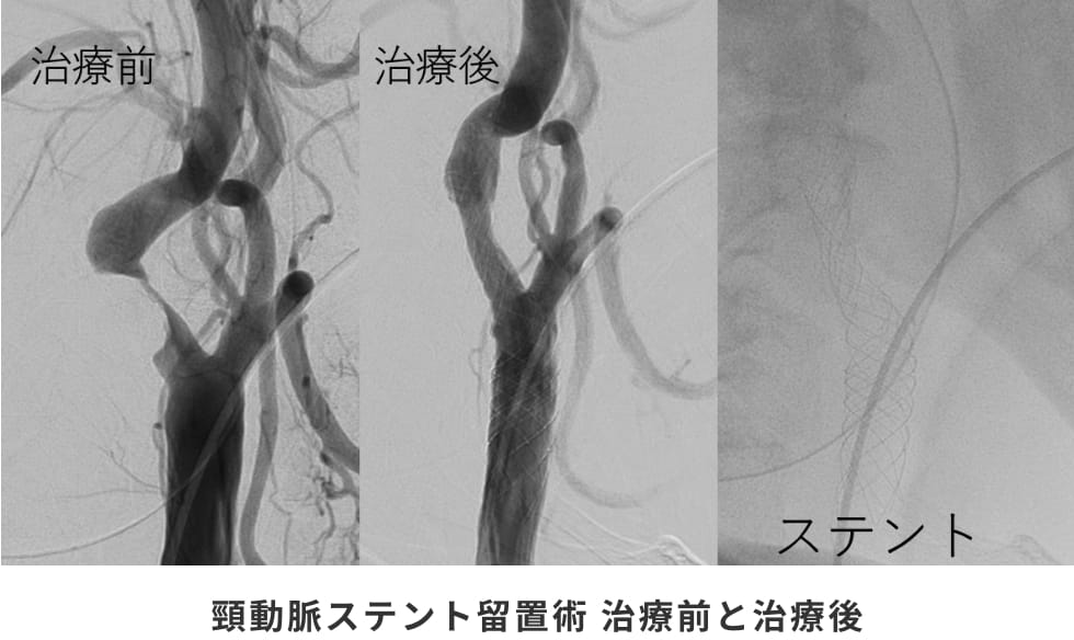 頸動脈ステント留置術 治療前と治療後